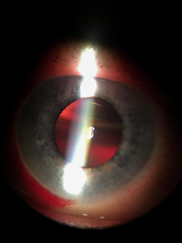 The gas in the eye after the surgery - pars plana vitrectomy